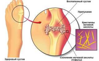 Симптомы и способы лечения подагры на пальцах рук: полезные советы