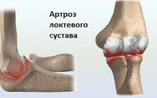 Что такое шпора локтевого сустава и как ее лечить правильно?
