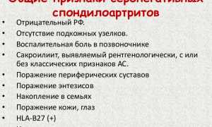 Симптомы и методы лечения серонегативного спондилоартрита у пациентов