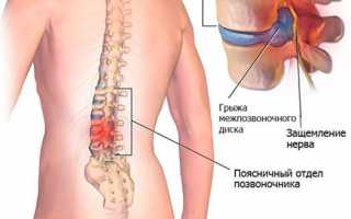 Что такое вертеброгенная люмбалгия? Узнайте основные причины