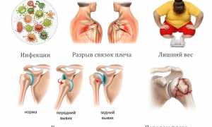 Возникновение болей в плечевом суставе после сна: причины и рекомендации