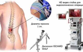 Эффективность эндоскопического удаления грыжи позвоночника: современные методы и результаты