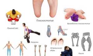 Виды и характерные признаки развития плоскостопия у детей и взрослых