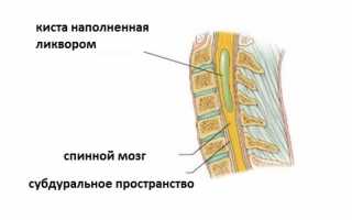 Появление кисты в пояснично-крестцовом отделе позвоночника: причины и последствия