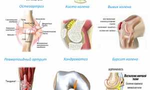 Как лечить воспаление в коленном суставе? Полезные советы и рекомендации