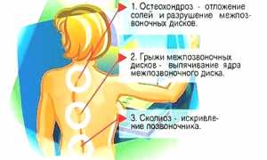 Что делать, если болит спина между лопатками? Полезные советы и рекомендации.