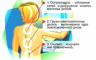 Что делать, если болит спина между лопатками? Полезные советы и рекомендации.