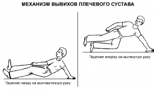 Признаки вывиха плеча и методы лечения травмы: важная информация для пациентов