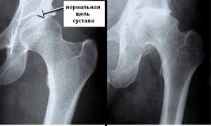 Коксартроз: классификация, симптомы и лечение заболевания суставов