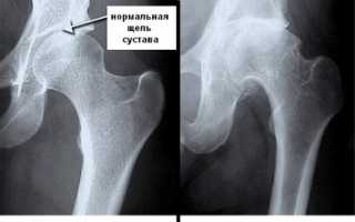 Коксартроз: классификация, симптомы и лечение заболевания суставов