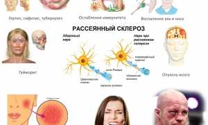 Симптомы защемления тройничного нерва и лечебные меры для облегчения состояния