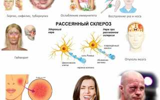 Симптомы защемления тройничного нерва и лечебные меры для облегчения состояния