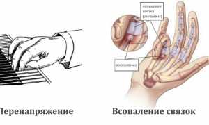 Причины появления гигромы на ладони и ее лечение: важные аспекты здоровья