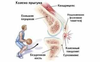 Признаки тендинита коленного сустава и способы его лечения: полезные советы