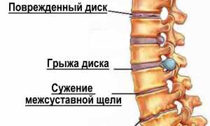 Лечебные меры при межреберном защемлении нерва: советы и рекомендации