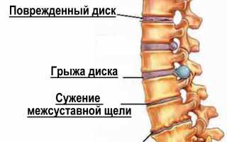 Лечебные меры при межреберном защемлении нерва: советы и рекомендации