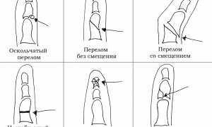 Признаки и лечение перелома большого пальца руки: советы и рекомендации