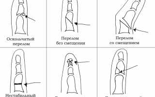 Признаки и лечение перелома большого пальца руки: советы и рекомендации