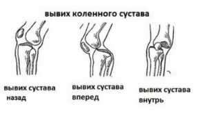 Признаки и способы лечения вывиха коленной чашечки у спортсменов