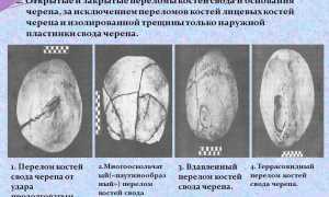 Виды, лечение и последствия перелома основания черепа: важная информация для пациентов