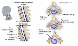 Почему хрустит шея при повороте головы? Узнайте причины и решения