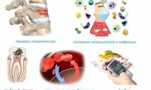 Причины возникновения остеомиелита позвоночника и его лечение: важные аспекты