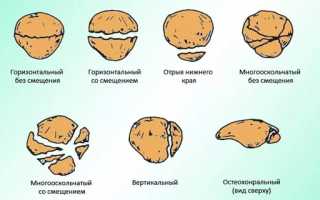 Лечебные меры при переломе коленной чашечки: советы и рекомендации