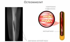 Развитие остеомиелита после травм, переломов и операций: причины и последствия