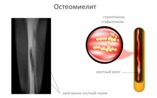 Развитие остеомиелита после травм, переломов и операций: причины и последствия