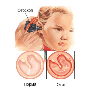 признаки отита