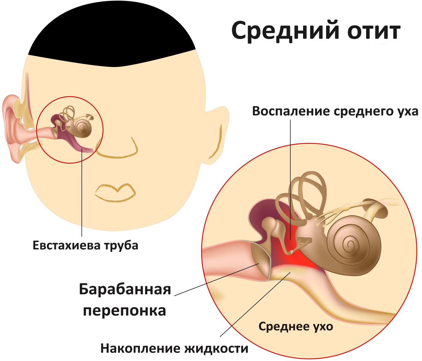Средний отит