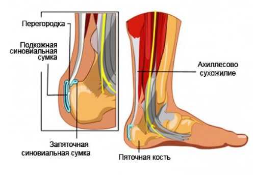 Ахиллобурсит