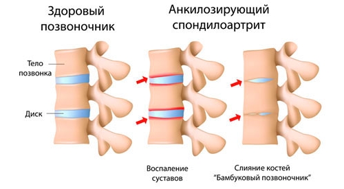 Анкилозирующий спондилоартрит