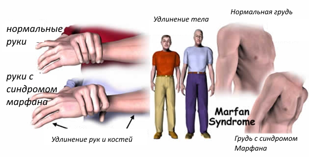Арахнодактилия при синдроме Марфана