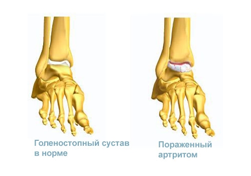 Артрит голеностопного сустава