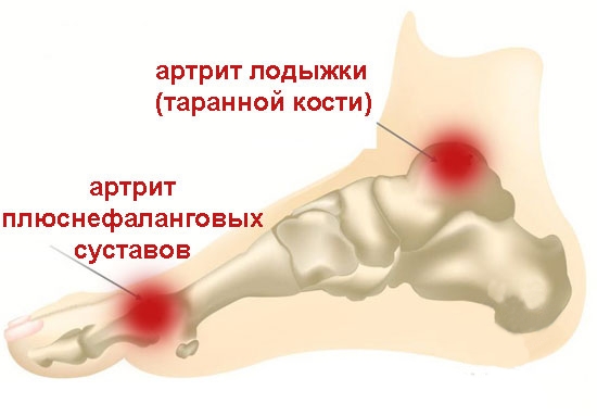 Артриты стопы