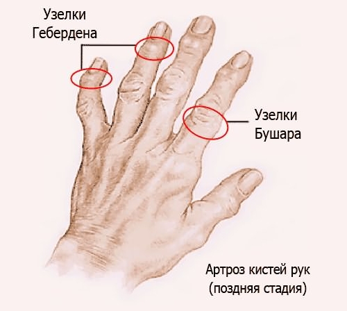 Узелки Гебердена и Бушара