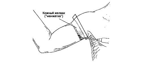 Блокада межреберно-плечевого нерва и медиального кожного нерва плеча