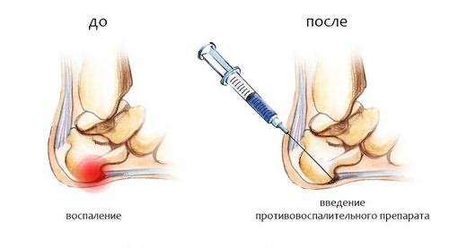Блокада при пяточных шпорах