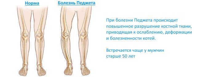Болезнь Педжета