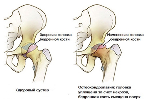 Болезнь Пертеса головки бедра