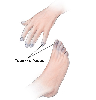 Синдром Рейно