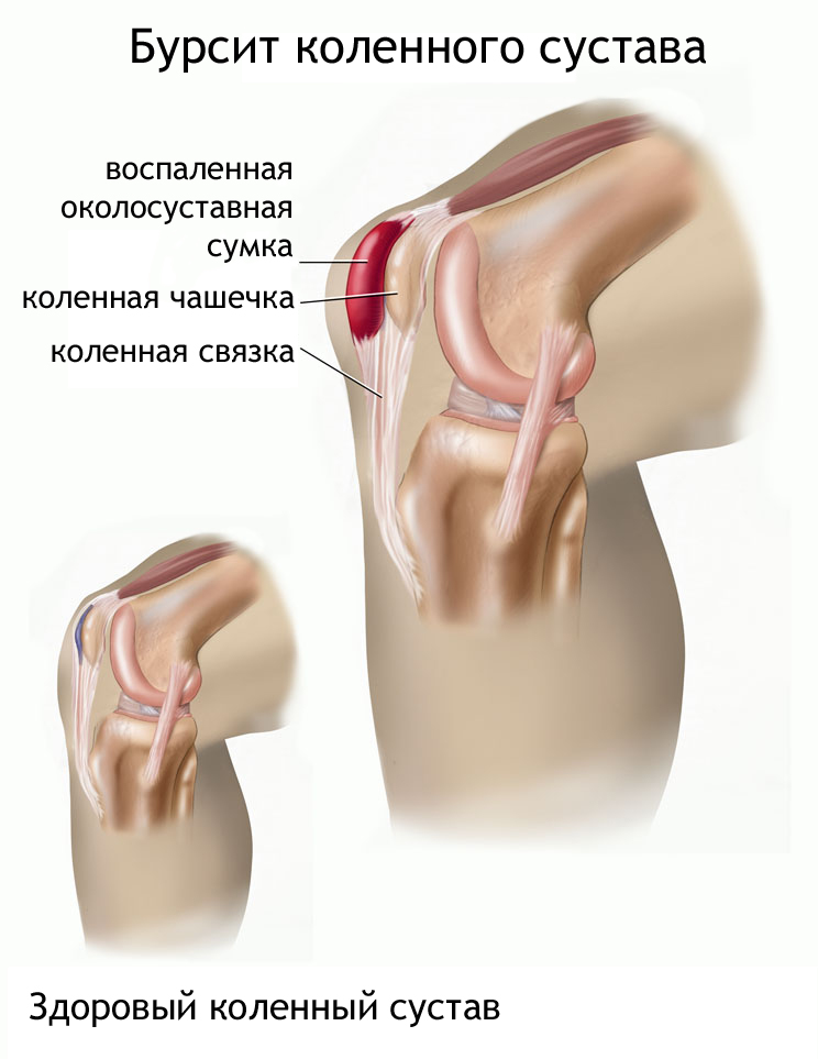 Бурсит — воспаление коленного сустава