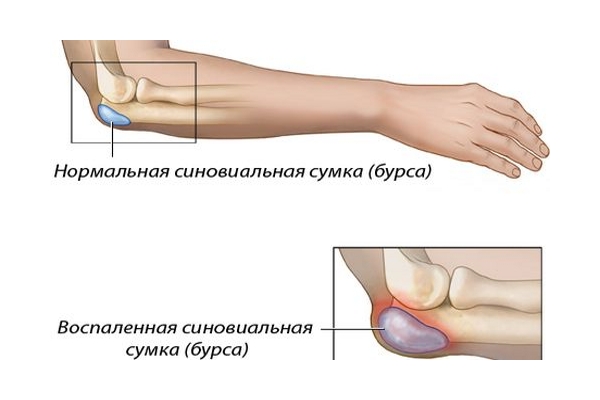 Развитие бурсита