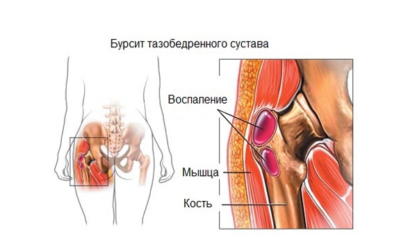 Бурсит тазобедренного сустава