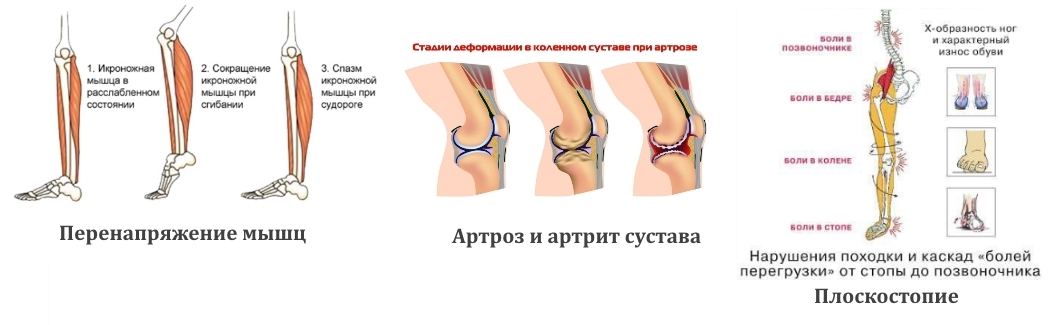 Частые причины боли в ногах