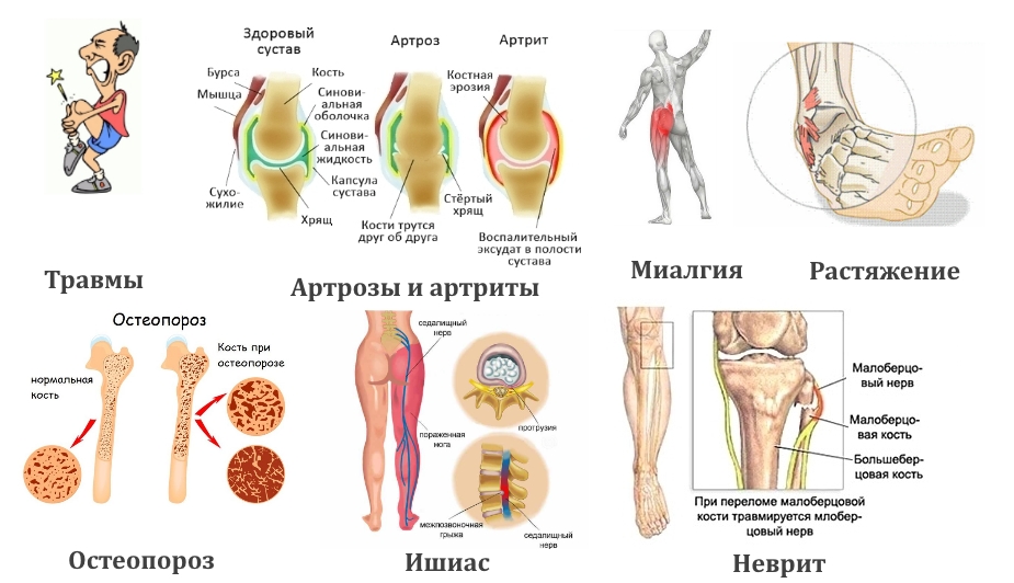 Частые причины боли в ноге