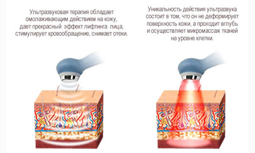 Действие ультразвуковой терапии