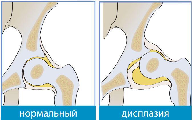Дисплазия тазобедренного сустава