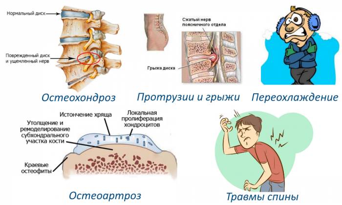 Факторы люмбоишиалгии